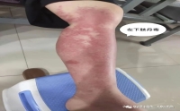 【皮膚科普知識(shí)】何為丹毒？如何解毒？帶您了解